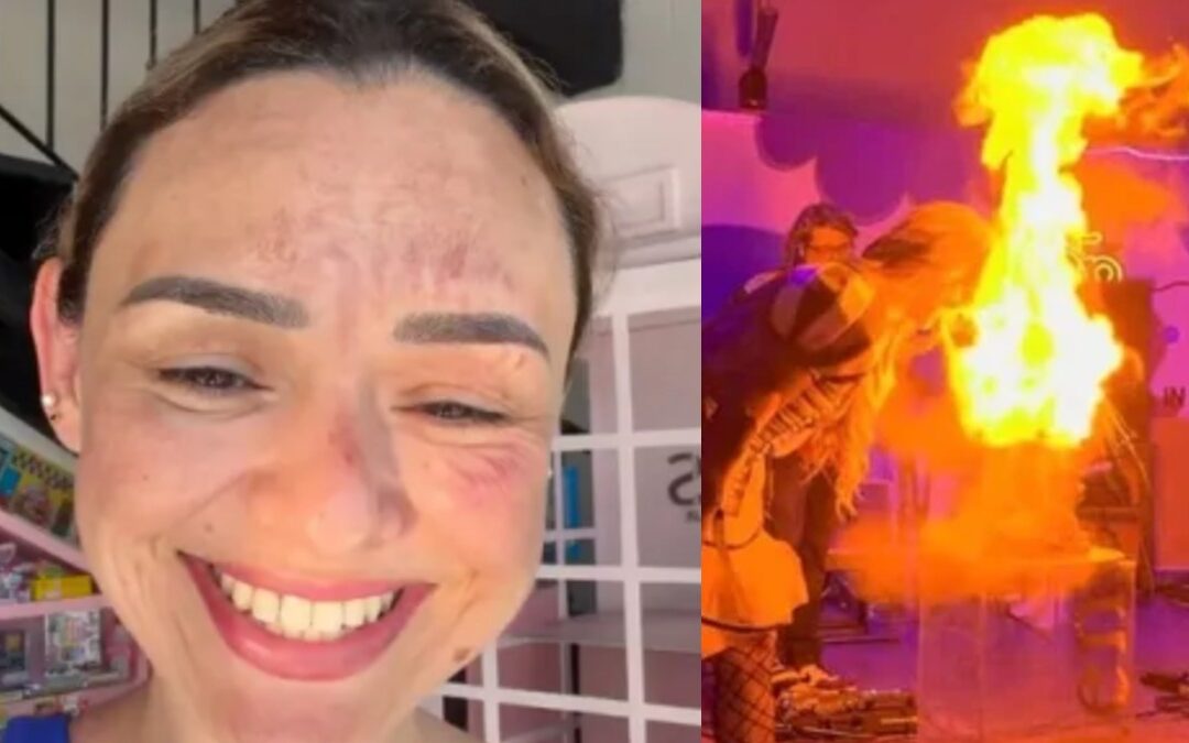 Accidente Facial de la Influencer Arlen Hernández por un Pastel Explosivo en Hartford