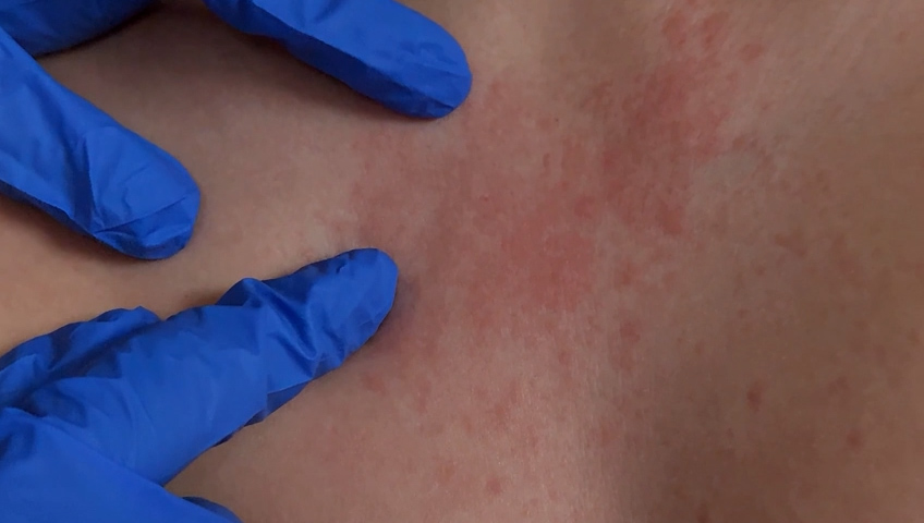 Alerta de Salud: Brote de Sarampión en Mexicali Genera Preocupación